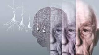 مرض الزهايمر يهاجم أهل الفن !