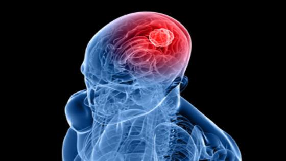 دراسة : حمض الأولييك قد يساهم في منع الإصابة بسرطان الدماغ