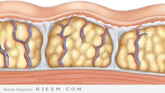 كيفية التخلص منزلياً من السيلوليت بالوصفات الطبيعية