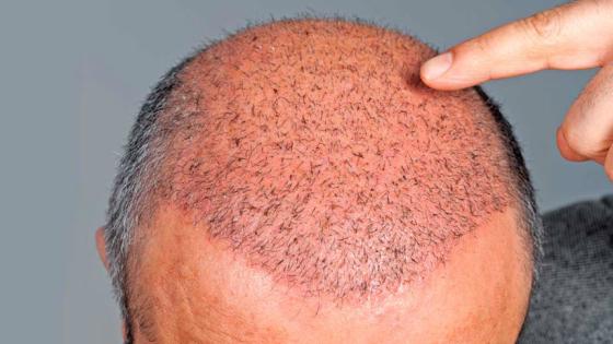 تعرّف على وقت ظهور نتائج عملية زراعة الشعر